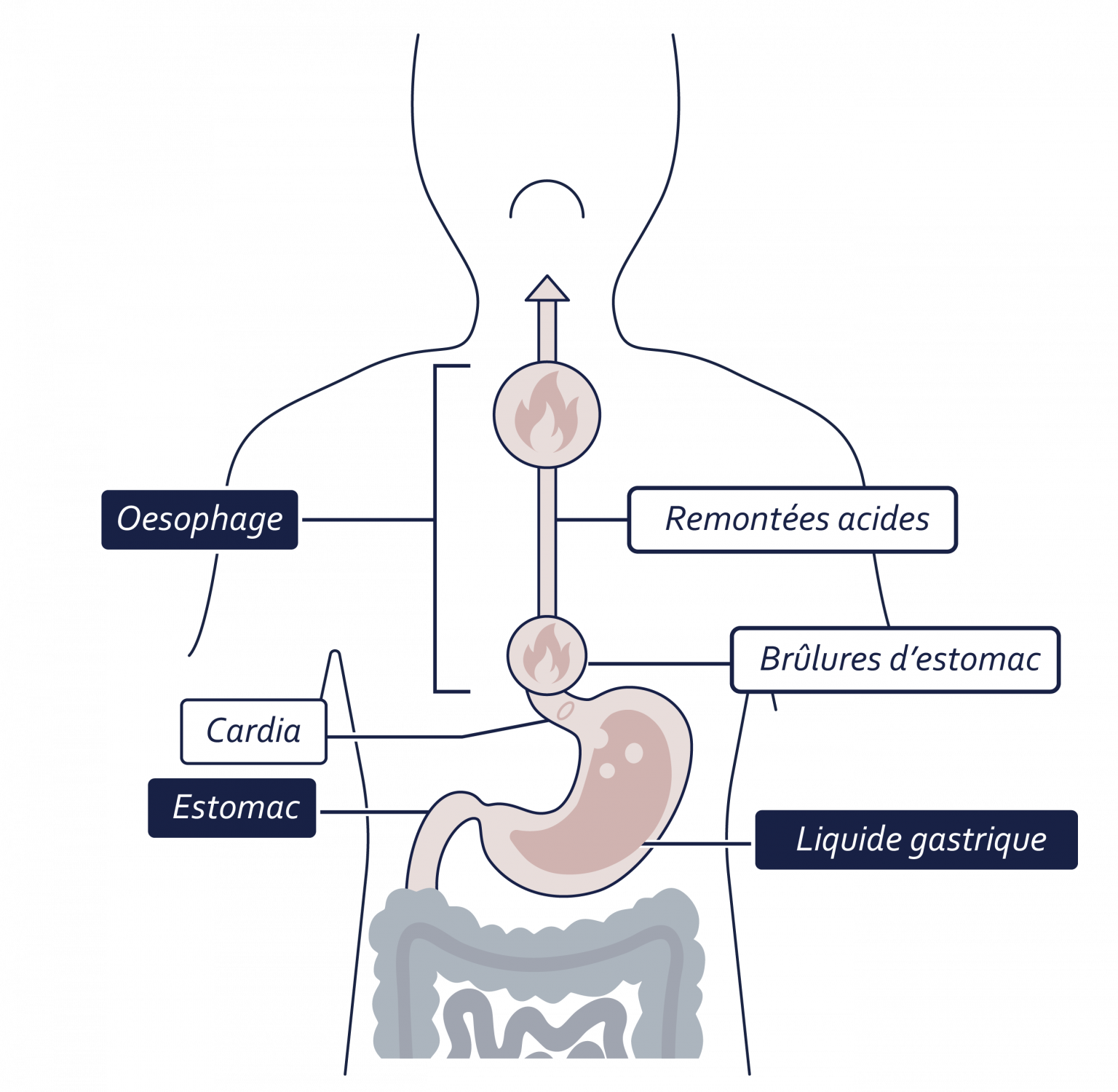 Reflux Gastro Sophagien Rgo Laboratoires Grimberg